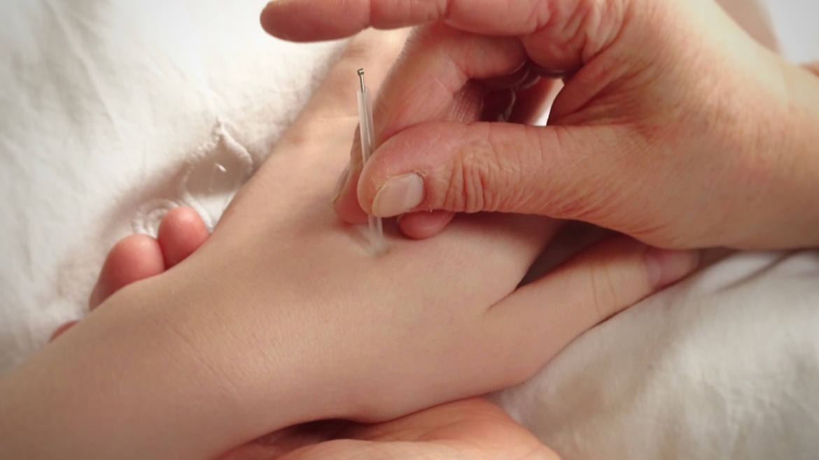 Acupuntura (Mestre Tung + Sistêmica)